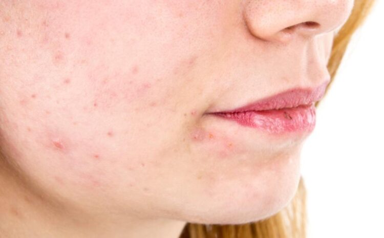  Si t’i shmangemi alergjive të kozmetikës